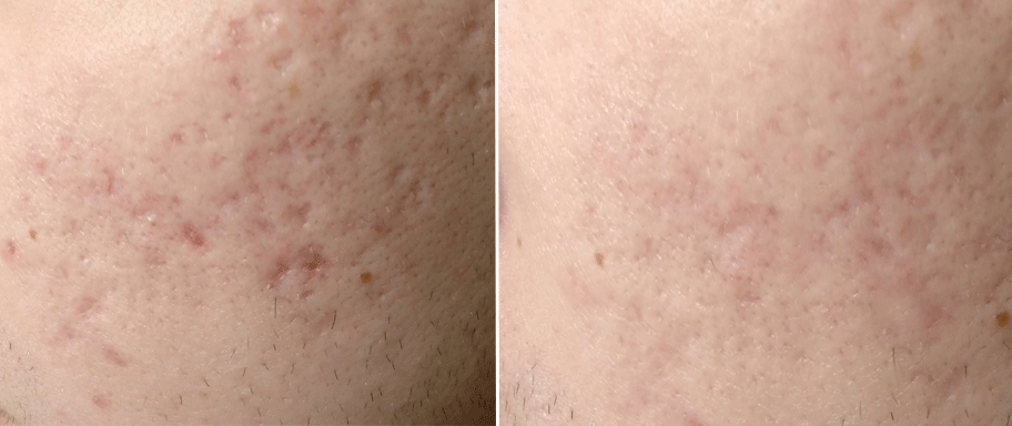 Вугровий висип