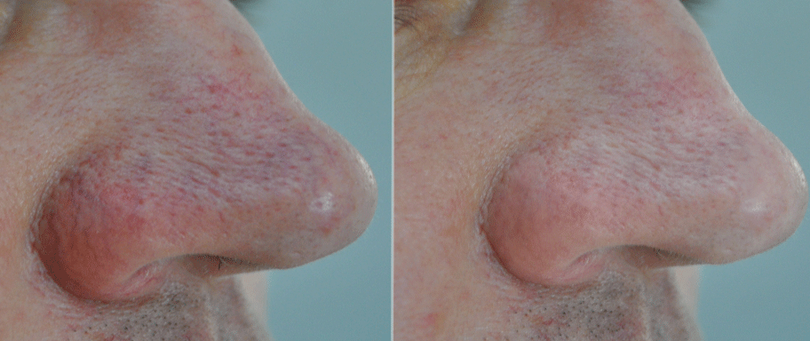 Видалення судин Київ 