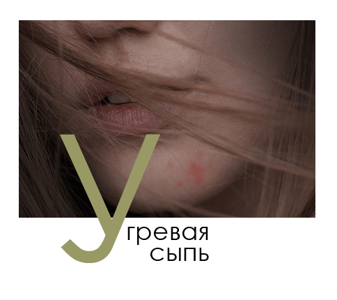 Вугровий висип